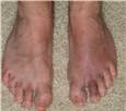 BrokenToe.JPG