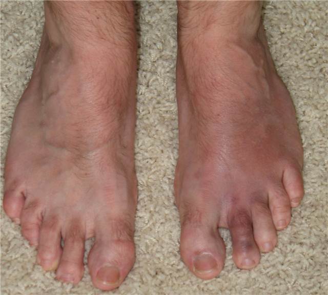 BrokenToe.JPG